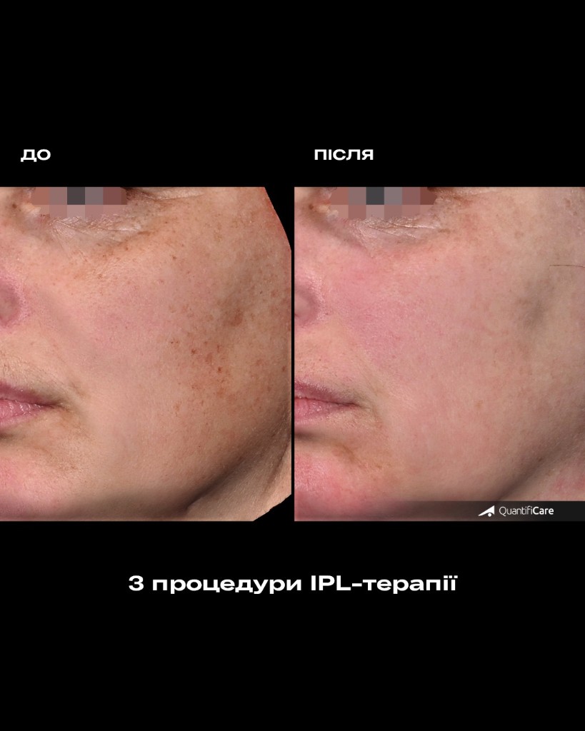 Результат IPL-терапії до і після, приклад 2