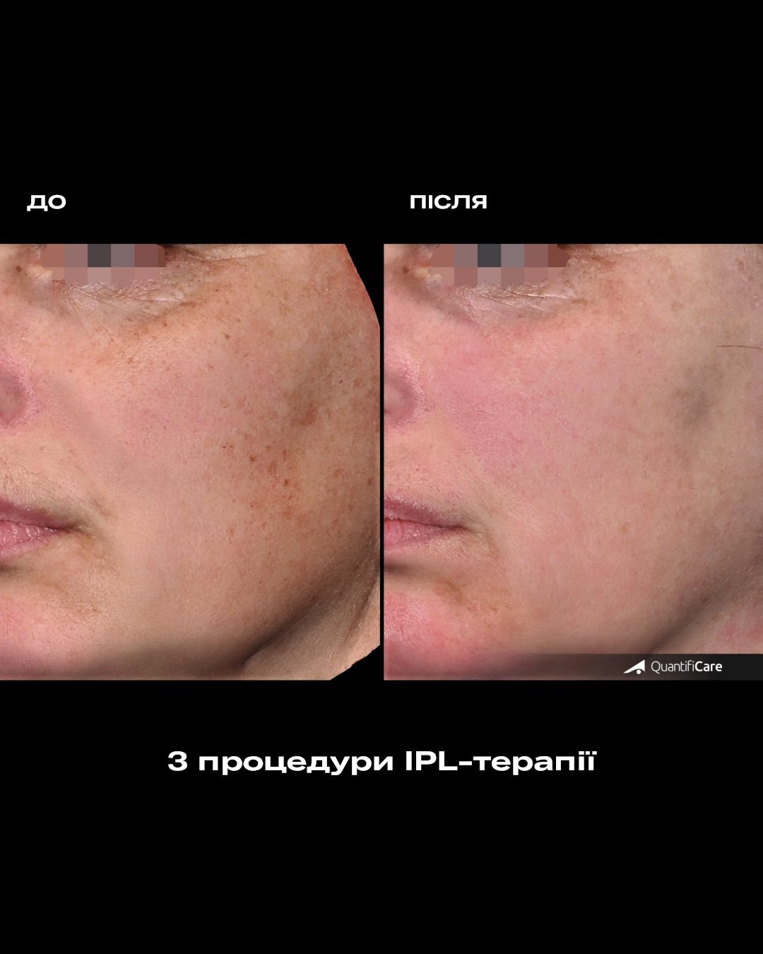 Результат IPL-терапії до і після, приклад 4