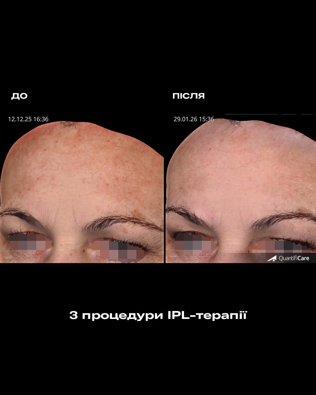Результат IPL-терапії до і після, приклад 5